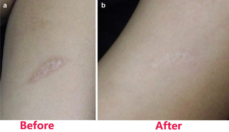 co2 fractional laser treatment before and after