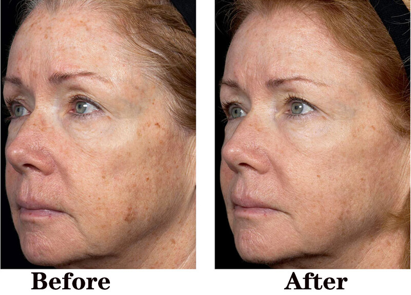 co2 fractioanl laser treatment before and after