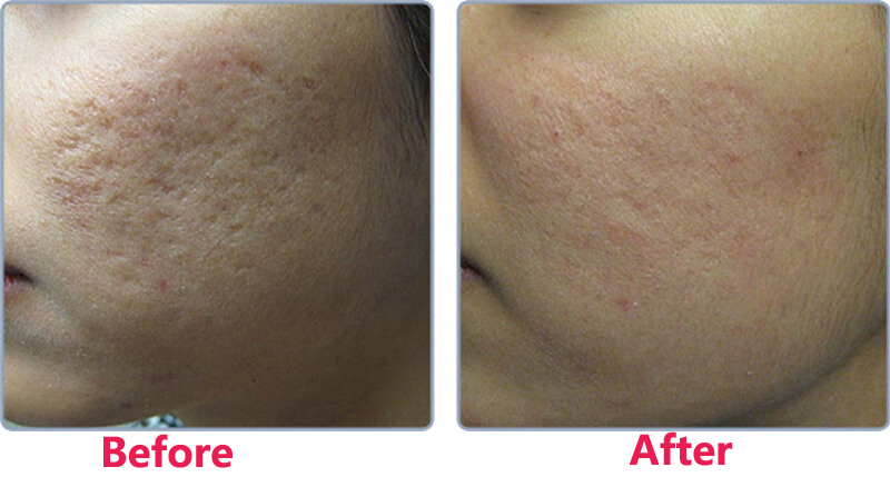 co2 fractional laser treatment before and after