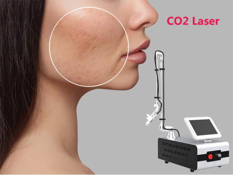 co2 fractional laser teatment