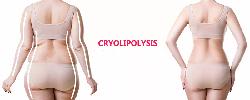 cryolipolysis slim treatment