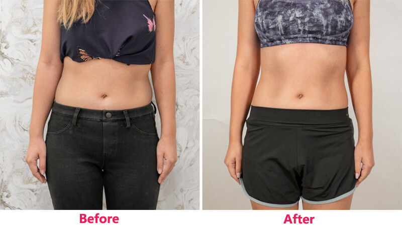 cryolipolysis slim treatment before and after