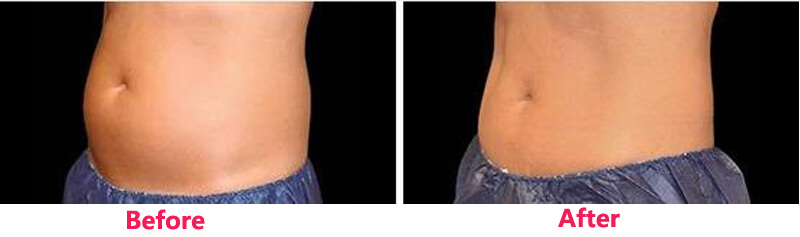 cryolipolysis slim treatment before and after