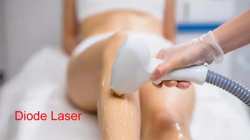 laser hair removal treatment