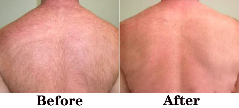 laser hair removal treatment before and after