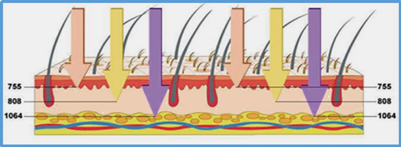 diode laser hair removal machin