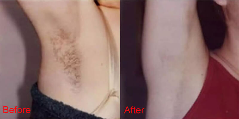 laser hair removal treatment before and after