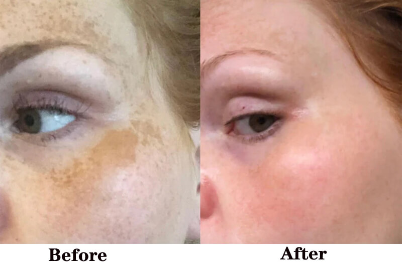 ipl laser treatment before and after