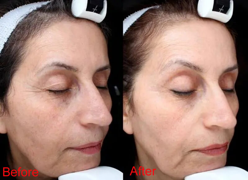 picosecond laser treatment before and after