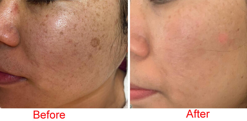 nd yag laser machine treatment before and after
