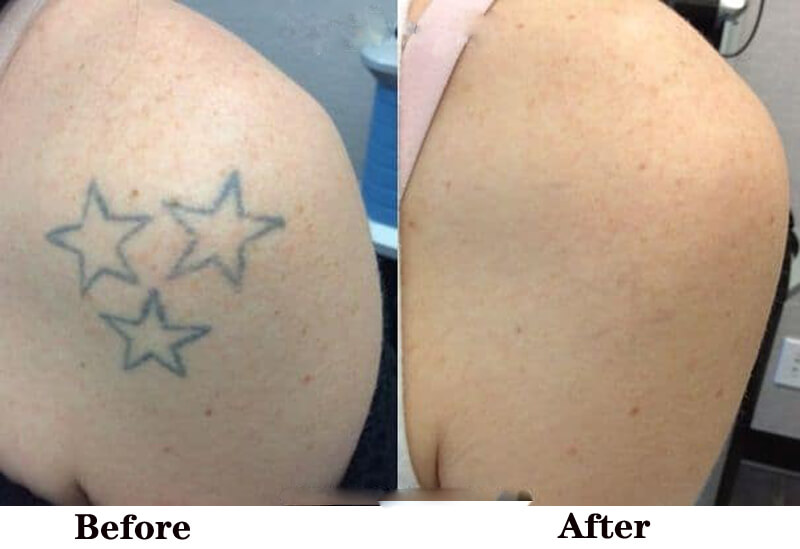 picosecond laser treatment before and after