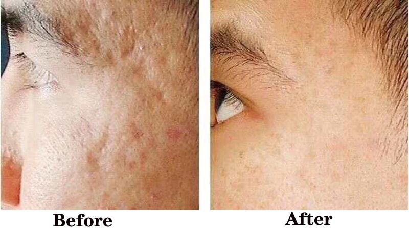 co2 fractional laser treatment before and after
