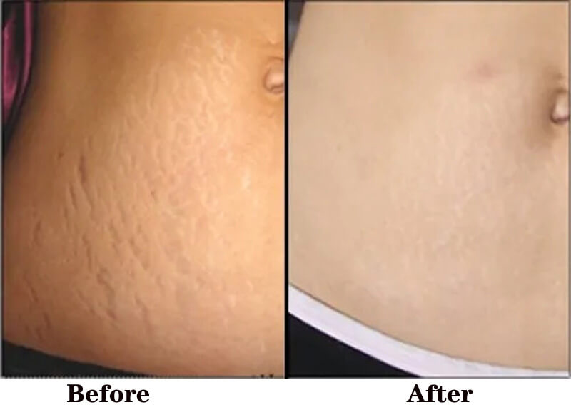  fractional co2 laser stretch marks