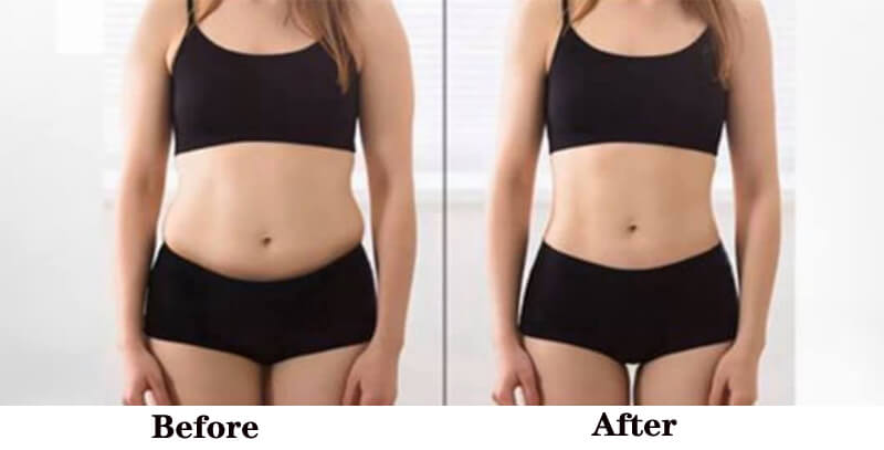 cryoliposysis slimming treatment before and after