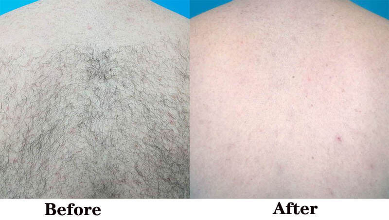 laser hair removal treatment