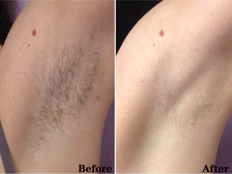 laser hair removal treatment before and after