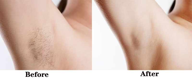 laser hair removal machine treatment before and after