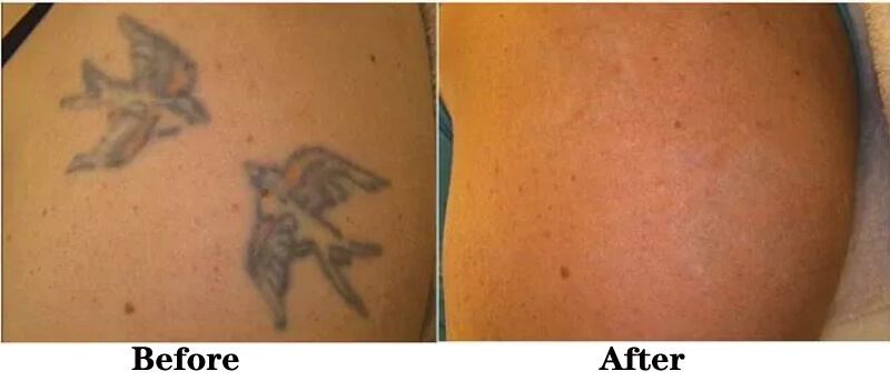nd yag laser tattoo removal treatment