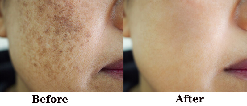 nd yag laser treatment before and after