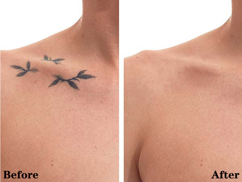 picosecond laser tattoo removal treatment