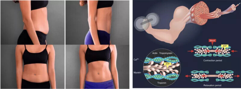 emdculpt slimming machine