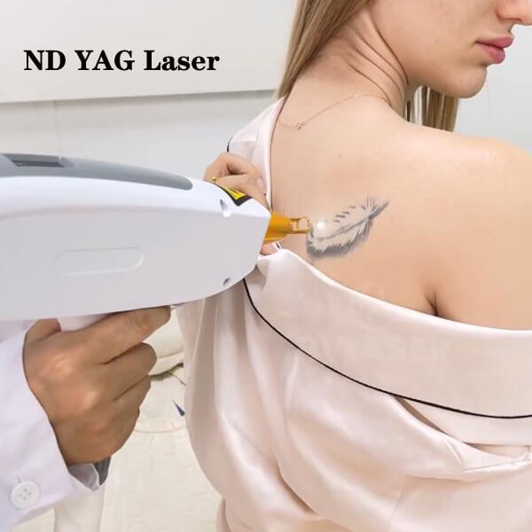 Questions You Should Know About Q-switched ND YAG Laser