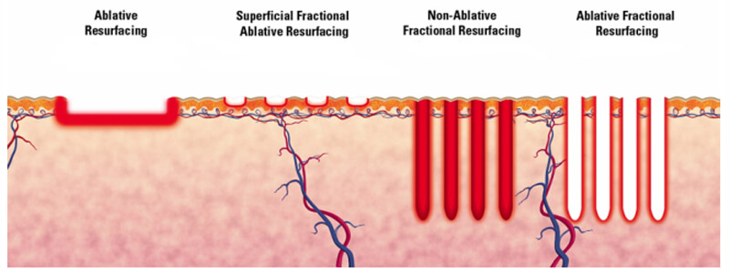 co2 fractional laser treatment