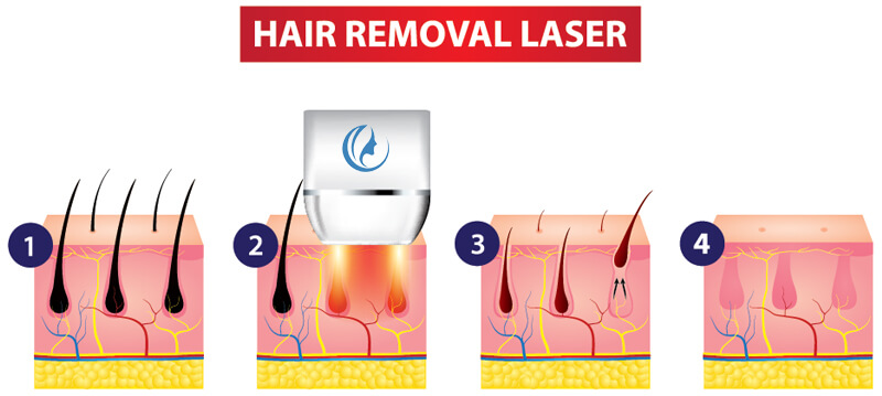 diode laser hair removal machine