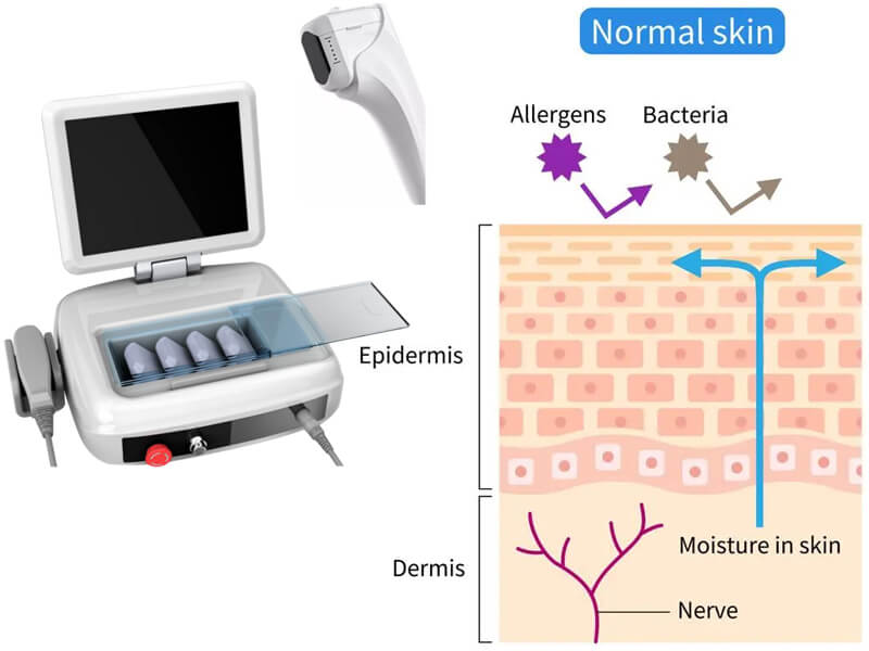 hifu ultrasound machine