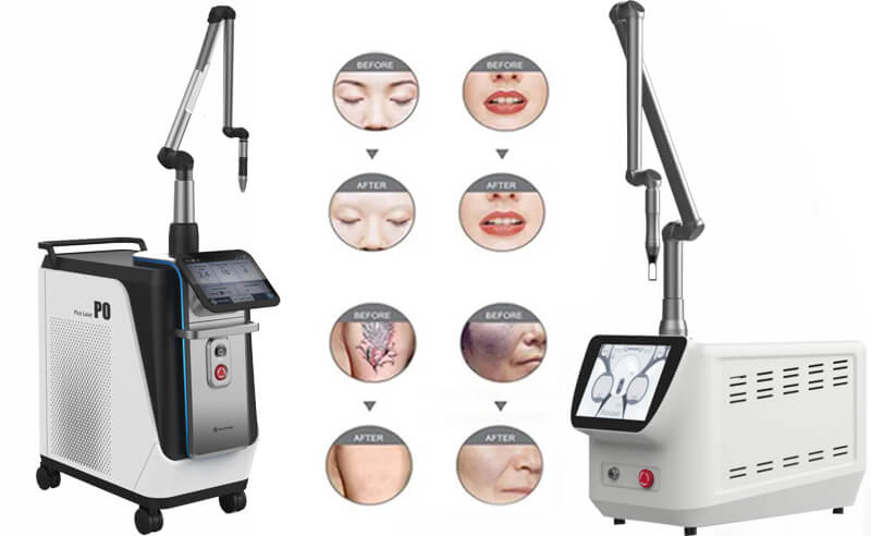 picosecond laser tattoo removal machine