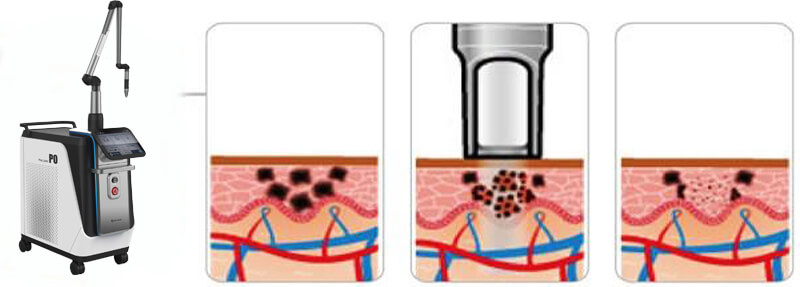 picosecond laser tattoo removal machine