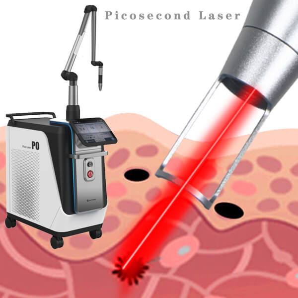 All Things You Need To Know About The Picosecond Laser Machine