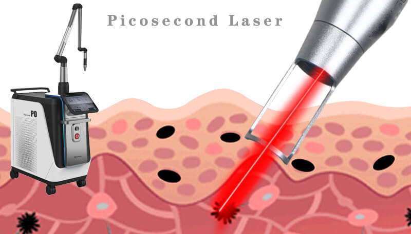 picosecond laser tattoo removal machine