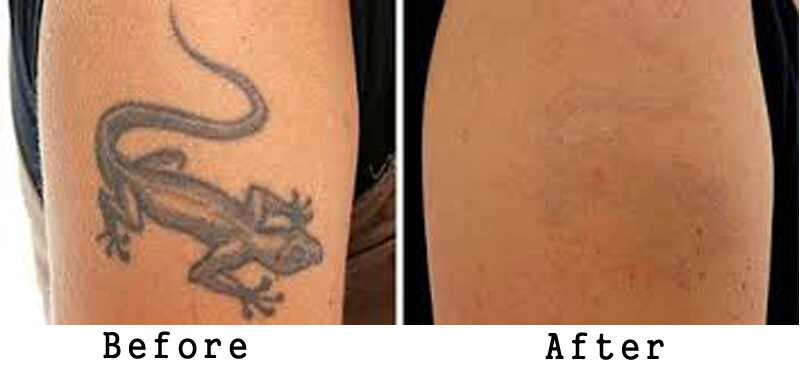 nd yag laser tattoo removal treatment before and after