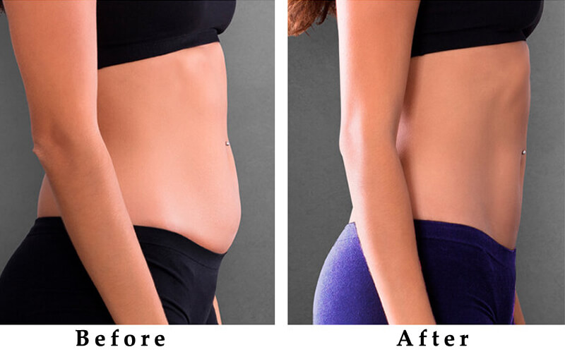 body sculpting machine treatment before and after