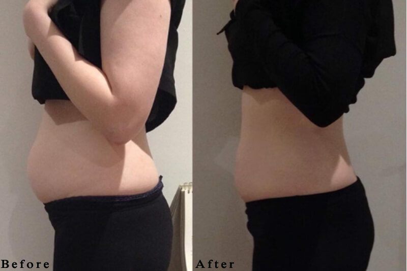 cryolipolysis slimming machine treatment before and after