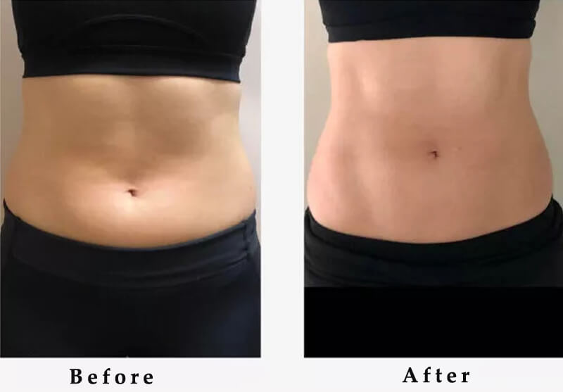 emsculpt slim treatment before and after