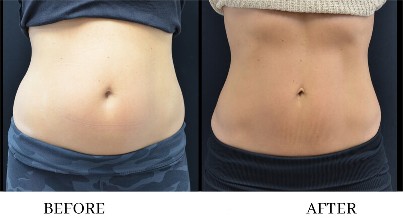 emsculpt slimming treatment before and after