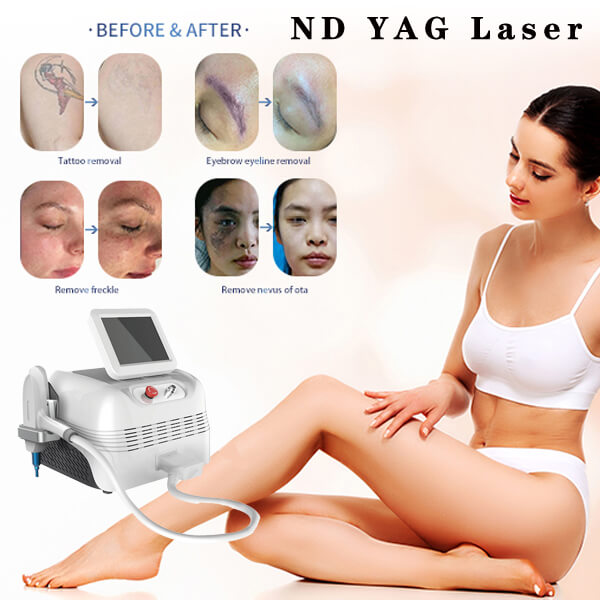 The success rate of ND YAG laser tattoo removal treatment