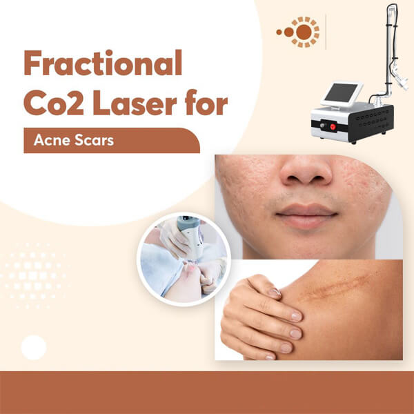 CO2 fractional laser for scar removal
