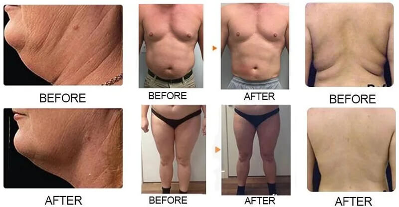 cryolipolysis machine treatment before and after