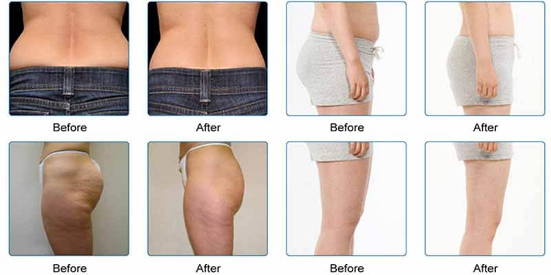 cryolipolysis treatment before and after