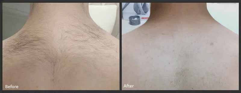 laser hair removal machine treatment before and after
