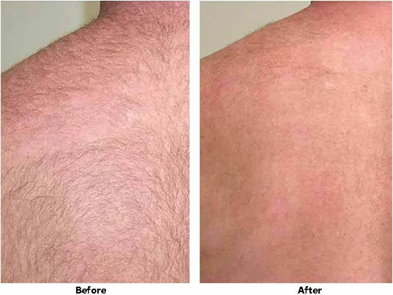 laser hair removal treatment before and after