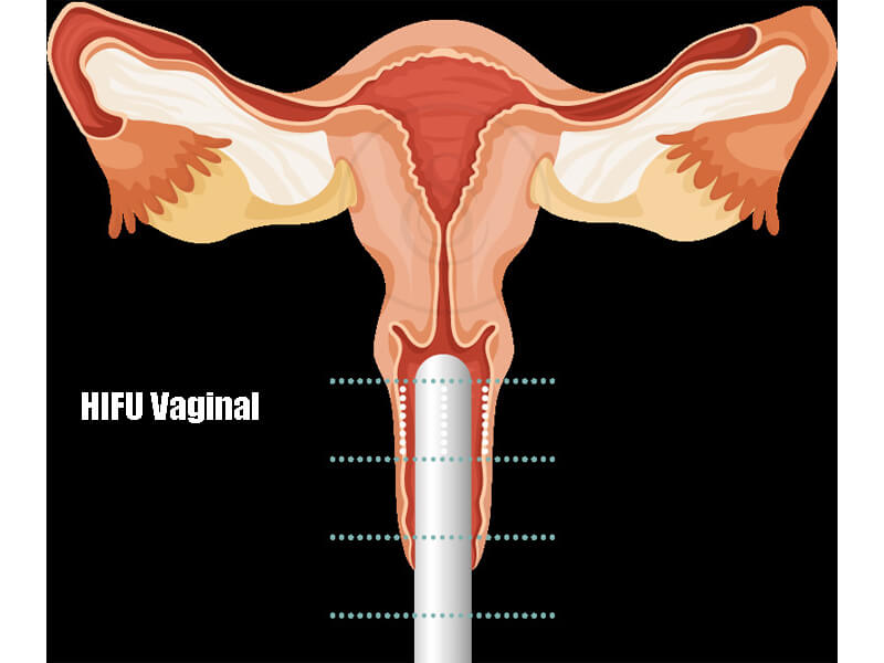 hifu vaginal tightening 