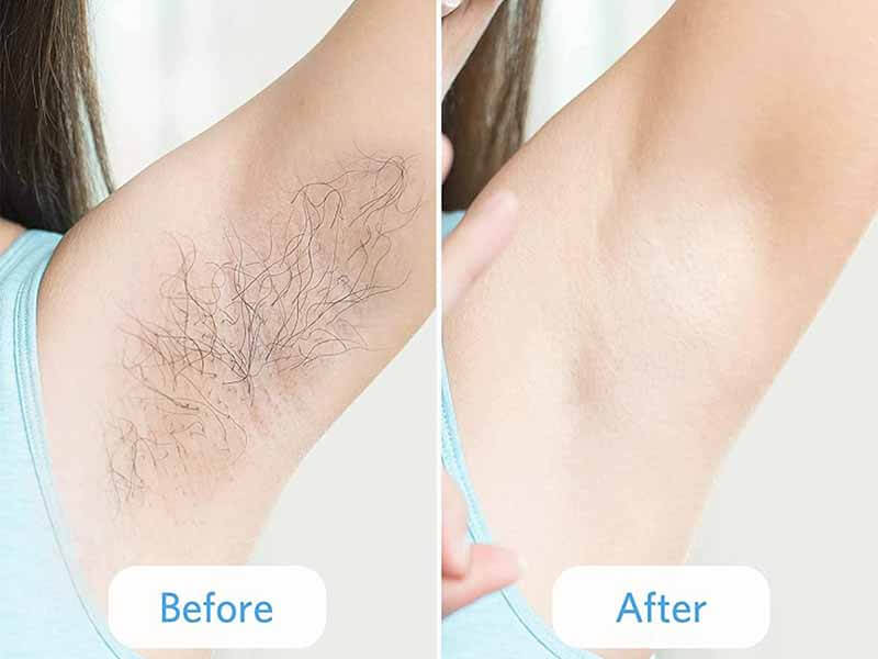ipl laser treatment before and after