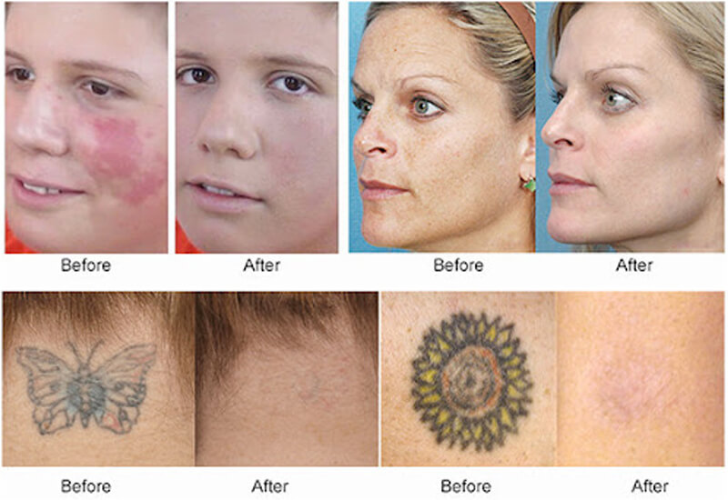 q-switched nd yag laser machine treatment before and after