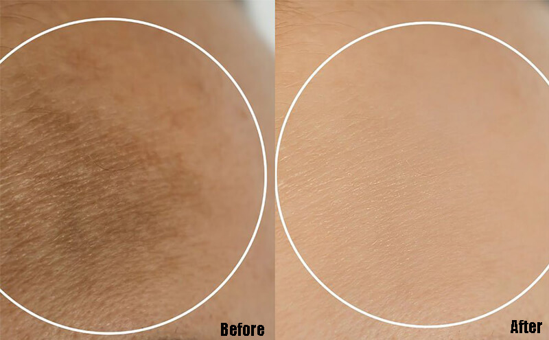 erbium glass laser treatment before and after