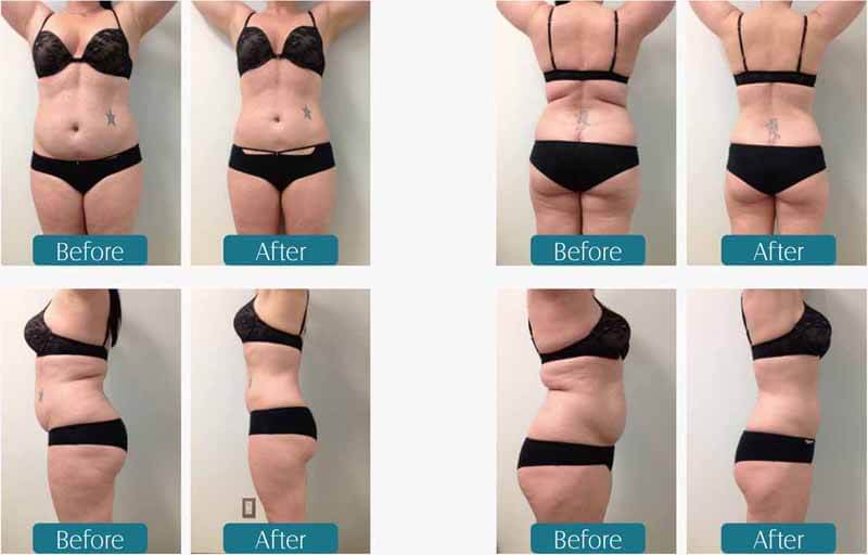 cryolipolysis slimming treatment before and after