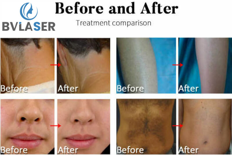 laser hair removal machine treatment before and after